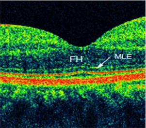 OCT : réalisation et lecture de base